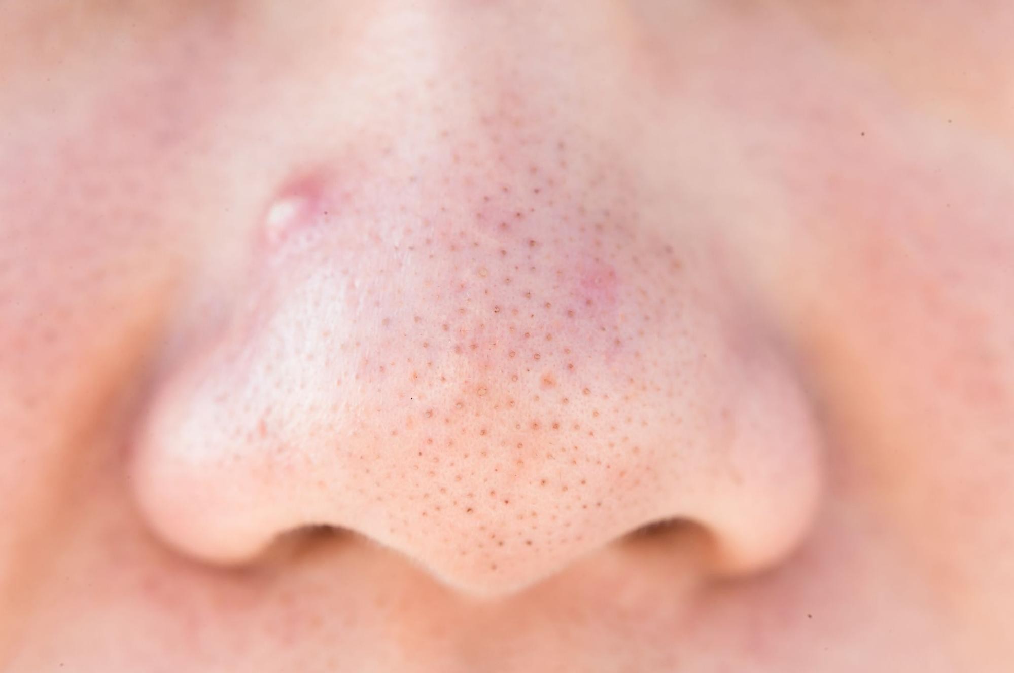 毛穴トラブルは皮膚科へ行くべき？おすすめ治療やセルフケア方法も解説
