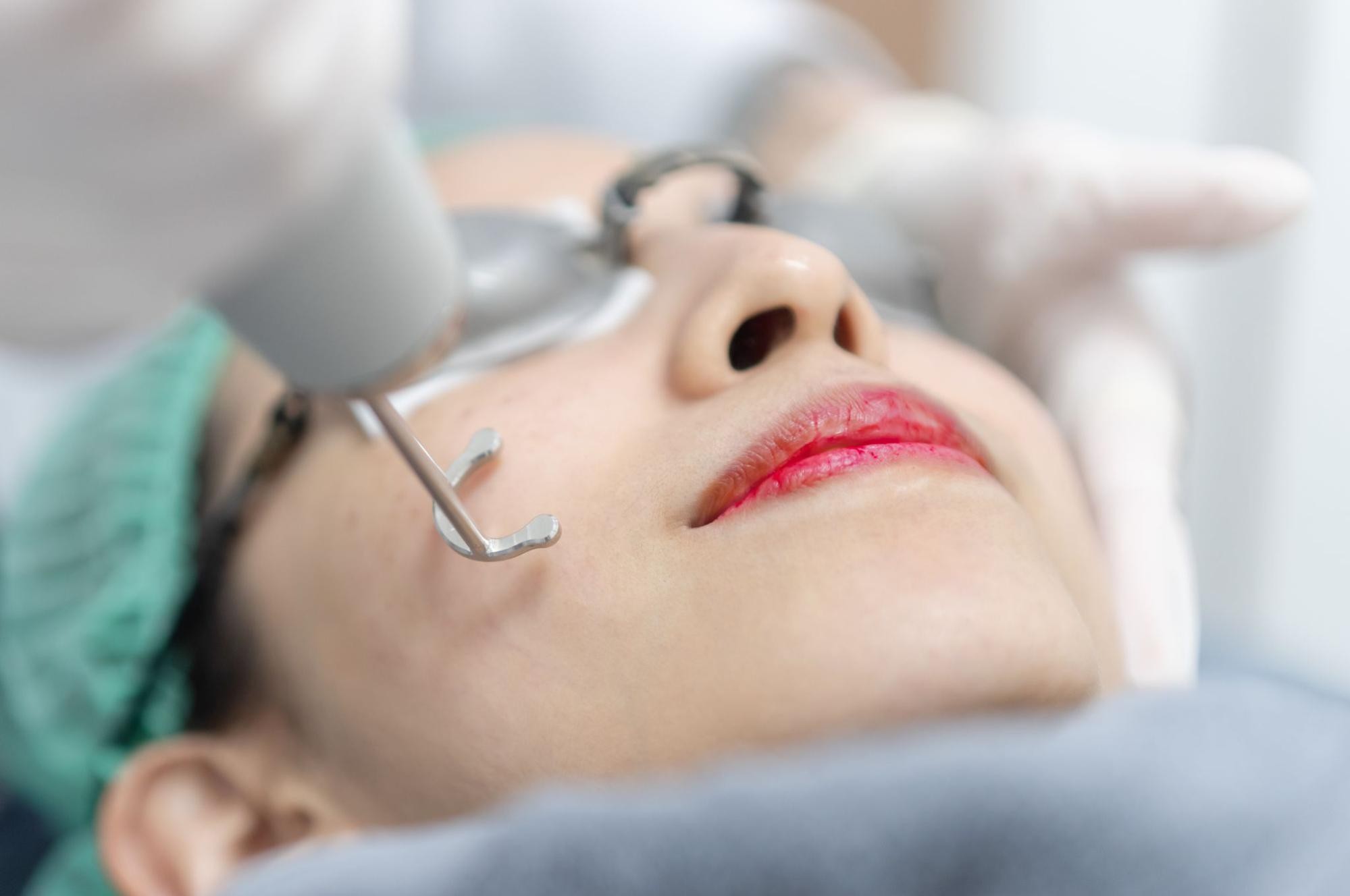 シミ取りレーザー