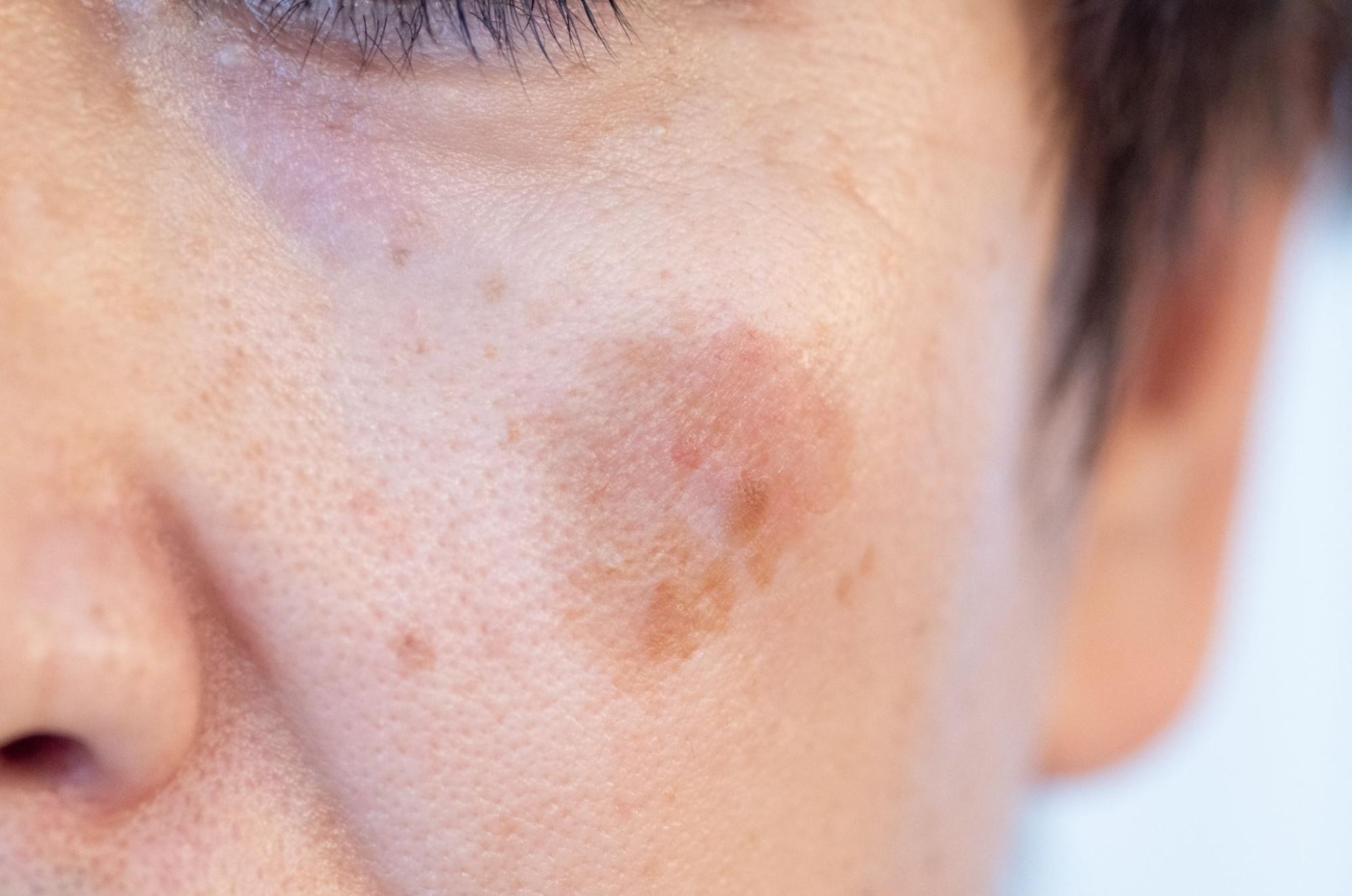 シミ取りレーザーができない人って？理由や治療の種類について解説