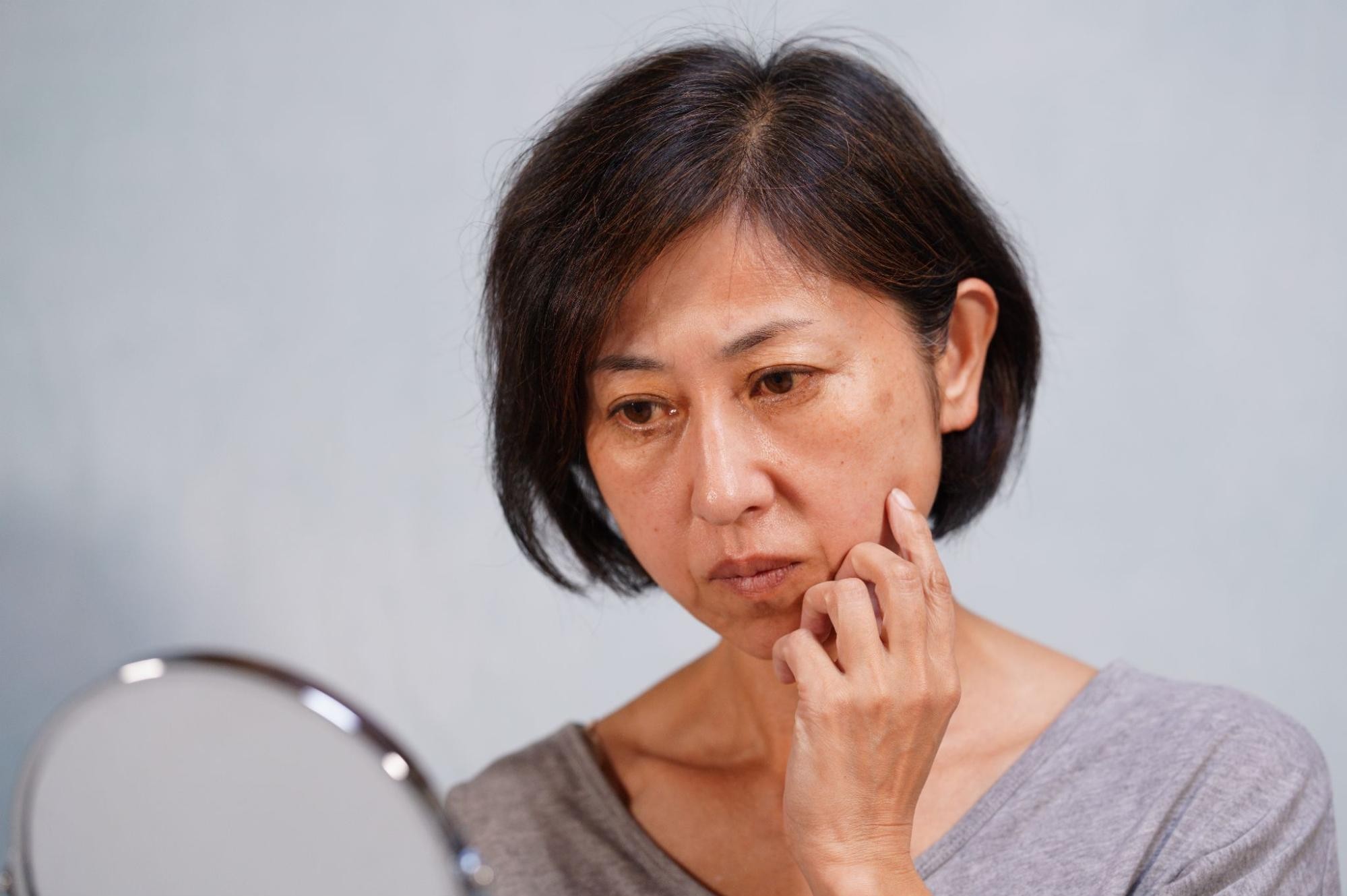 代表的なシミ取り治療種類